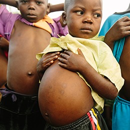 Children showing their swollen bellies from intestinal worms.