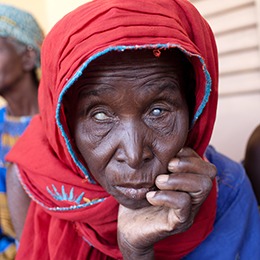 Woman with river blindness posing for picture.
