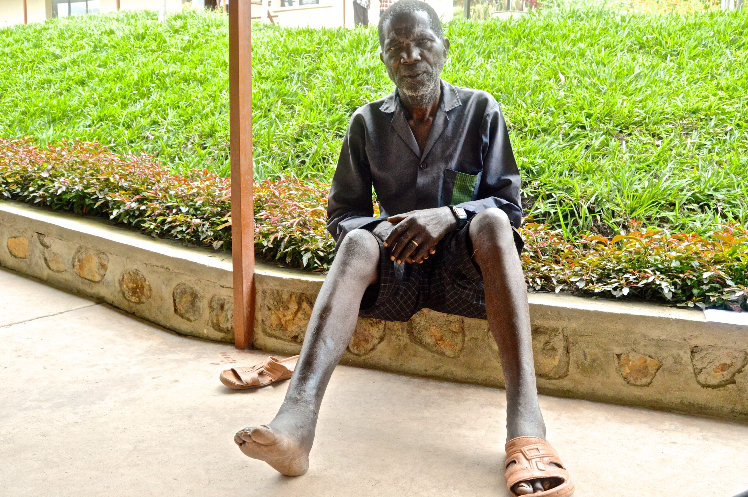 Man with elaphantiasis