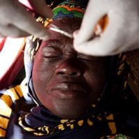 Woman during eye surgery.